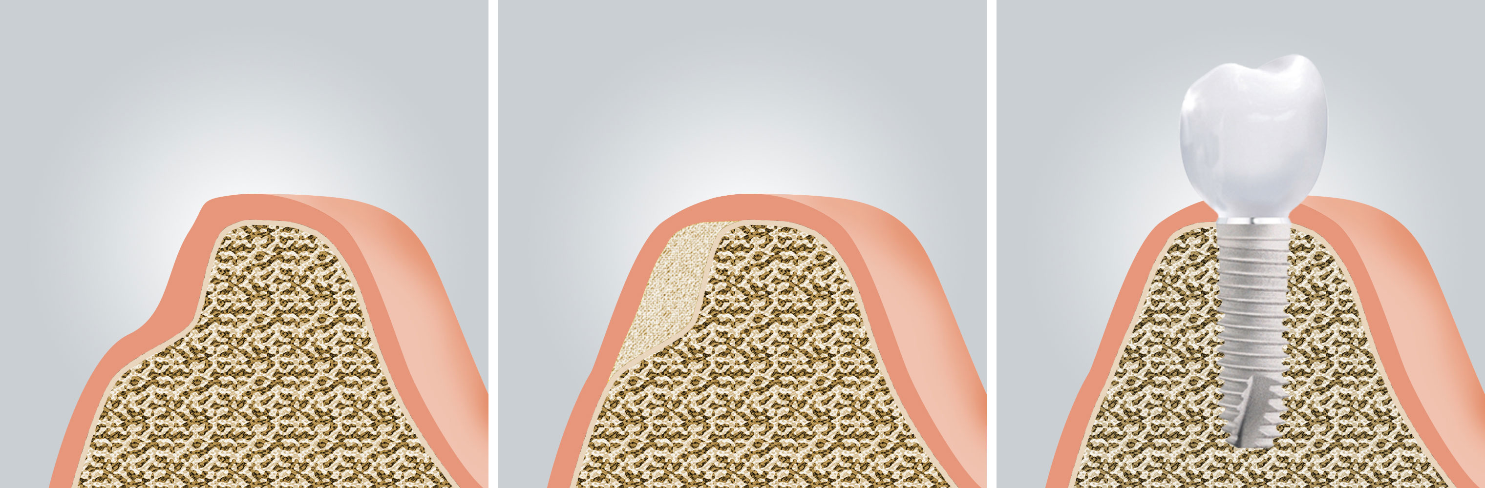 Für eine Implantation muss ausreichend Knochenvolumen vorhanden sein. Auch Patienten, die nach langer Zahnlosigkeit Knochen verloren haben, kann geholfen werden.